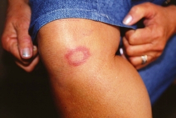 Janeiro é o mês de conscientização sobre a Hanseníase Janeiro é o mês de conscientização sobre a Hanseníase