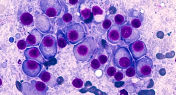 Aprovada nova terapia voltada para tratamento de mieloma múltiplo