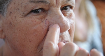 Brasileiros devem redobrar cuidados no verão contra câncer de pele