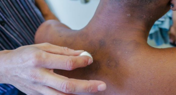 Inteligência artificial pode acelerar diagnóstico de hanseníase