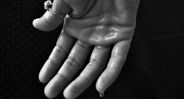 Quando o suor se transforma em doença: saiba mais sobre a hiperidrose