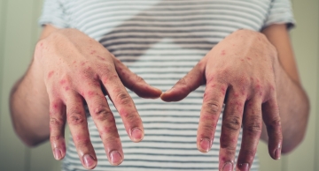 Por que casos de sarampo em SP acendem alerta para todo o Brasil