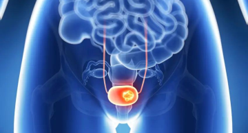 No mês da prevenção do câncer de bexiga, conheça os sinais da doença