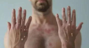 Botucatu registra primeiro caso da varíola dos macacos