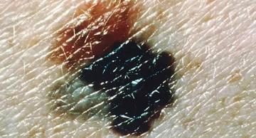 Terapia contra câncer de pele que usa técnica da vacina para Covid deve ficar pronta neste ano, dizem empresas