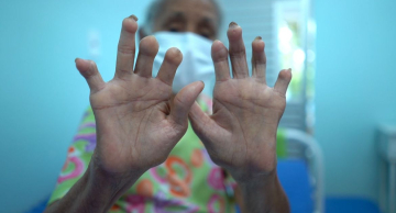 Campanha Janeiro Roxo luta contra preconceito referente à hanseníase