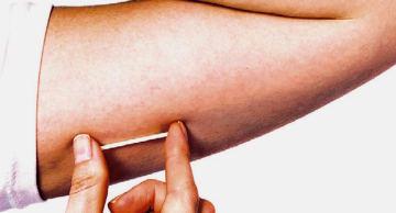 HCFMB recebe o Implanon NXT, método contraceptivo mais eficaz do mundo