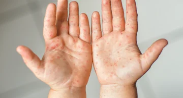 Casos da doença mão-pé-boca cresceram 149% no estado de SP em 2023