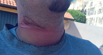 Fios de telefonia soltos deixam motociclista ferido em Botucatu