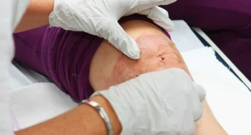 Pesquisa de em hospital de SP melhora cicatrização em 80%