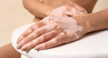 Estudo da FMB sugere que vitiligo pode gerar perda auditiva de origem neurológica