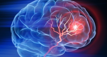 Secretaria da Saúde de SP registra aumento de 20% nos casos de AVC