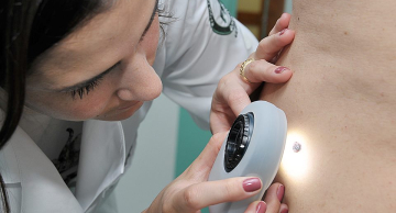 FMB/Unesp fará campanha para campanha de combate ao câncer de pele em Botucatu