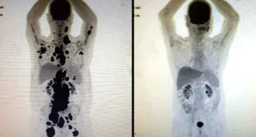 Entenda como funciona a terapia celular CAR-T Cell contra o câncer