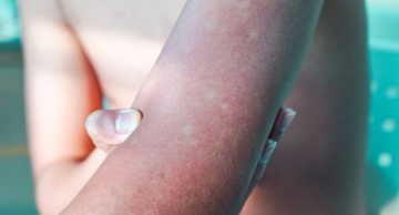 Entenda por que risco de ter dengue grave aumenta na segunda infecção