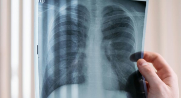 Dois novos casos de câncer de pulmão são diagnosticados no HC de Botucatu semanalmente