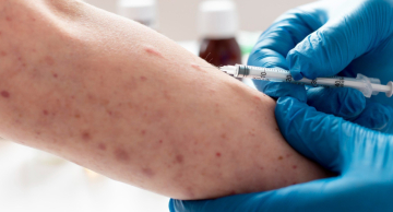 Infectologista do HC de Botucatu explica a disseminação da doença MPOX