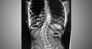 Pacientes do HC de Botucatu em fila de espera de escoliose serão beneficiados em mutirão cirúrgico