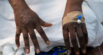 Nova cepa mais letal da mpox é confirmada em São Paulo: veja sintomas e transmissão Nova cepa mais letal da mpox é confirmada em São Paulo: veja sintomas e transmissão