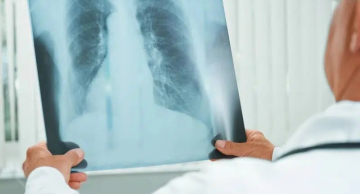 Unesp desenvolve medicamento inalável mais eficaz contra a tuberculose Unesp desenvolve medicamento inalável mais eficaz contra a tuberculose