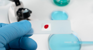 Estudo identifica proteínas envolvidas na eficácia de imunoterapia usada contra câncer no sangue