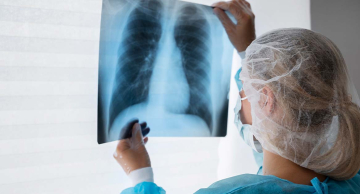 Agosto Branco reforça alerta sobre o câncer de pulmão Agosto Branco reforça alerta sobre o câncer de pulmão