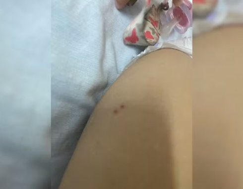 Bebê é internada no HC de Botucatu após suspeita de picada de cobra na região